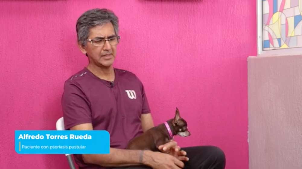 Alfredo: Paciente con Psoriasis Pustulosa